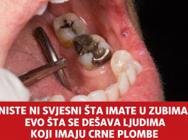 Niste ni svjesni šta imate u zubima! Evo šta se dešava ljudima koji imaju crne plombe (foto)